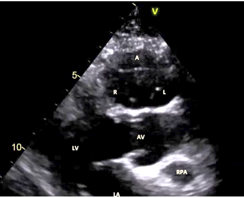 An unexpected sight - En face pulmonary valve